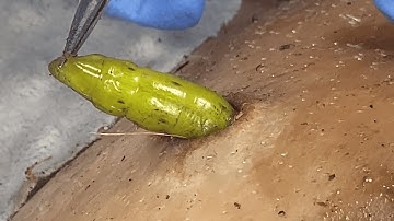 ASMR Giant Blackhead Extraction | Dr. Pimple Popper’s Most Satisfying Transformation 1011m2IMG 0844