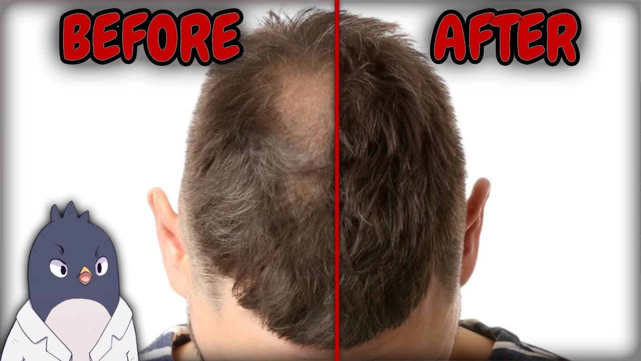 Special Vitamin E Helps Regrow 34 More Hair? YouTube