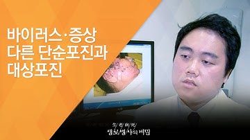 바이러스·증상 다른 단순포진과 대상포진 - (2014.7.23_510회 방송)_빨라야 산다! 통증의 왕, 대상포진