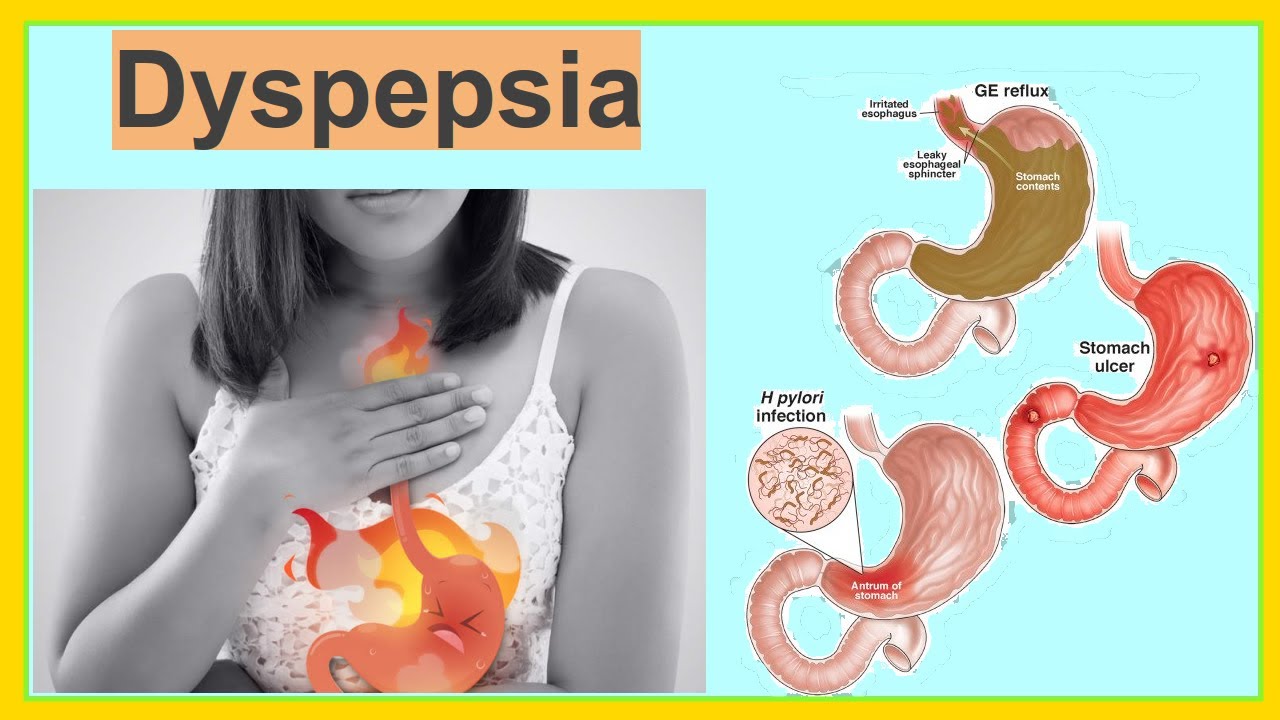 dyspepsia