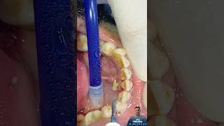 جير الأسنان || اسباب رائحة الفم الكريهة || نزيف اللثه || removal dental plaque #dentist