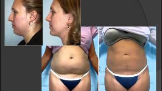 Lipólisis Láser o Smart Lipo