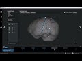 cortiQ 2.0 - AUTO-SNAP STEREO-EEG ELECTRODES WITH CT IMAGES