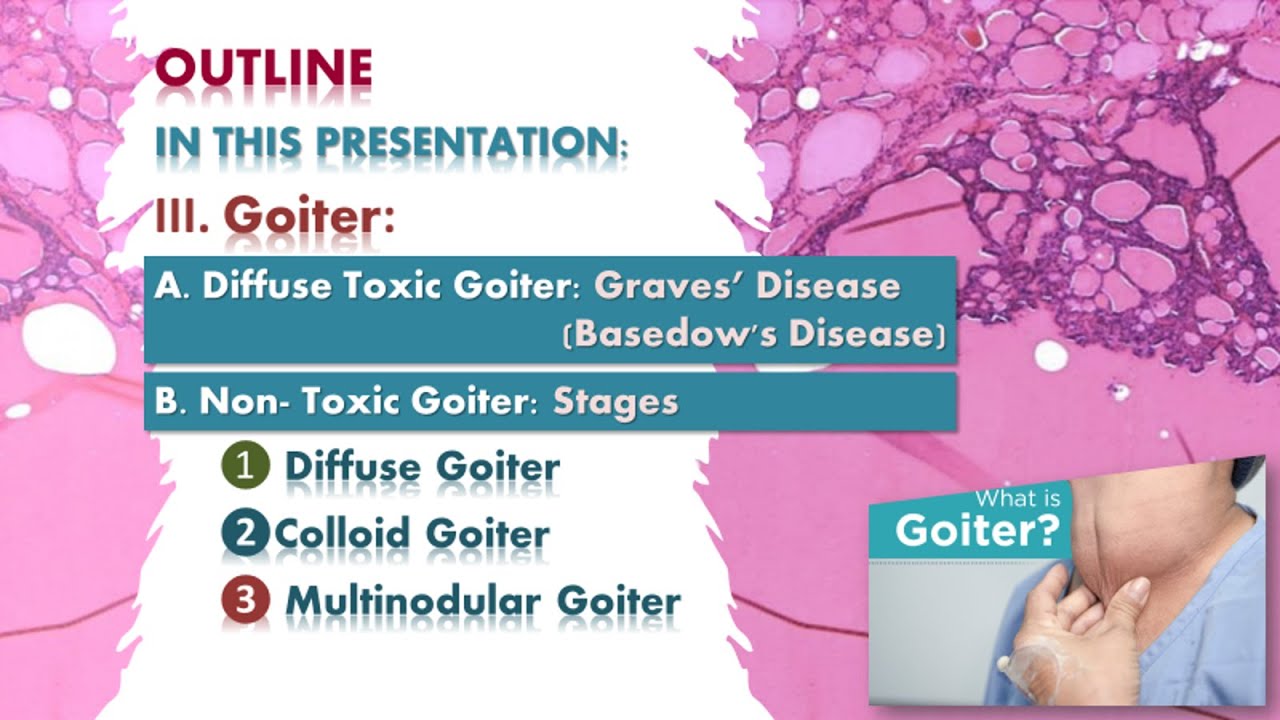 Goiter Graves' disease, multinodular goiter Thyroid lecture شرح محاضرة
