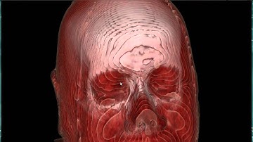 vtk ct head volume 1