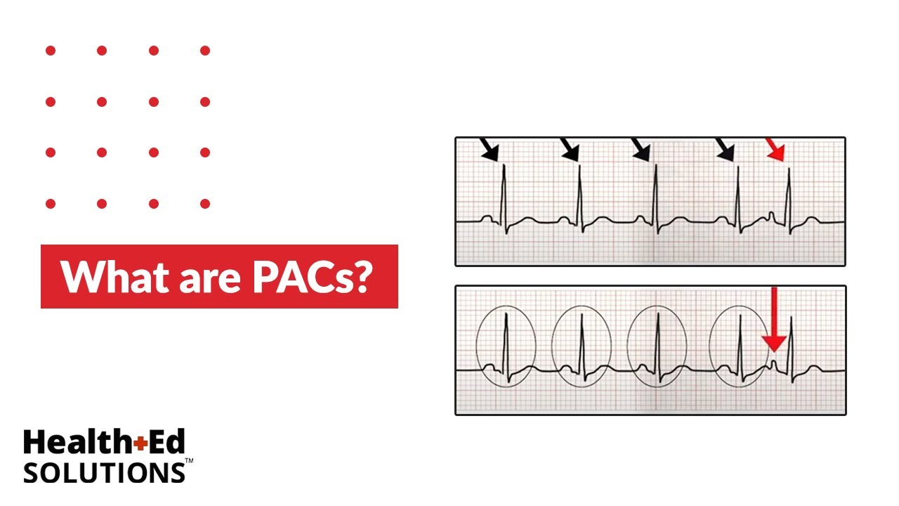Download One Quick Question: What are PACs (Premature Atrial Contractions)?