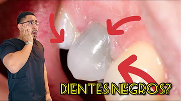 ¿Por qué algunas personas tienen los dientes negros?