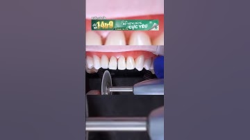 Những trường hợp nào cần mài kẻ răng trước khi niềng  #nhakhoa #niengrang #nhatkyniengrang #viral
