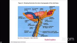 Gamma Knife Radiosurgery for Glomus Jugulare Tumors (Muhammad Abid Saleem)