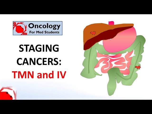 Staging cancers: TNM and I-IV systems