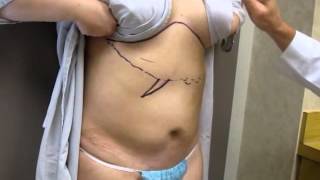 Reverse Tummy Tuck  Houston Plastic and Reconstructive Surgery