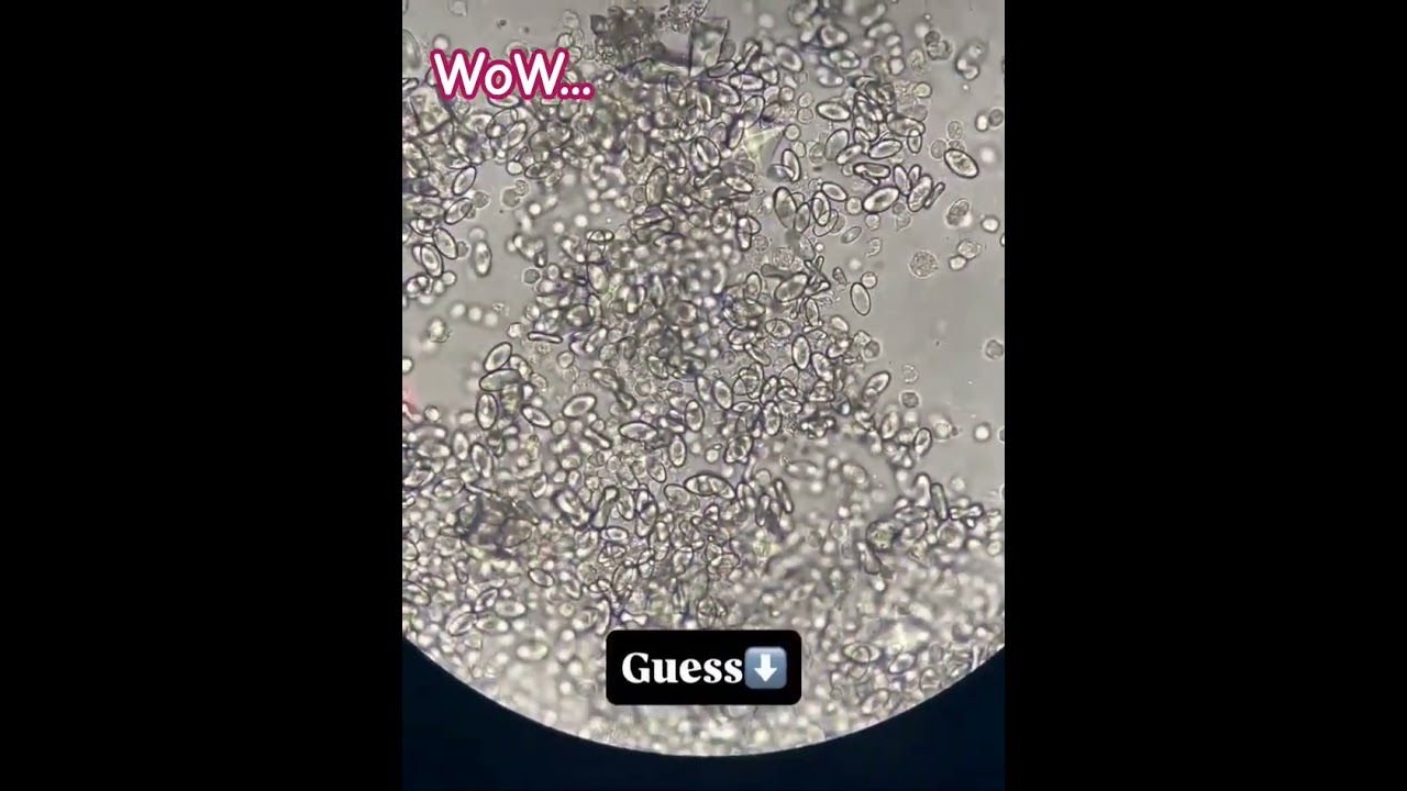 crystal sediment urine 