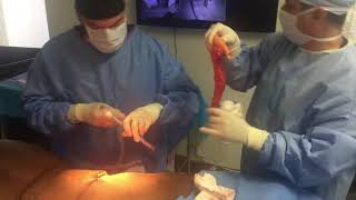 Dr. Moises Salama performs a #backlift (#bralinelift) to remove exc...