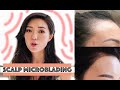 Scalp Microblading For Hair Loss + Cost