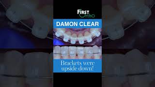 Damon Ultima - Quick and Accurate Results #EfficientOrthodontics #Braces #SmileTransformation