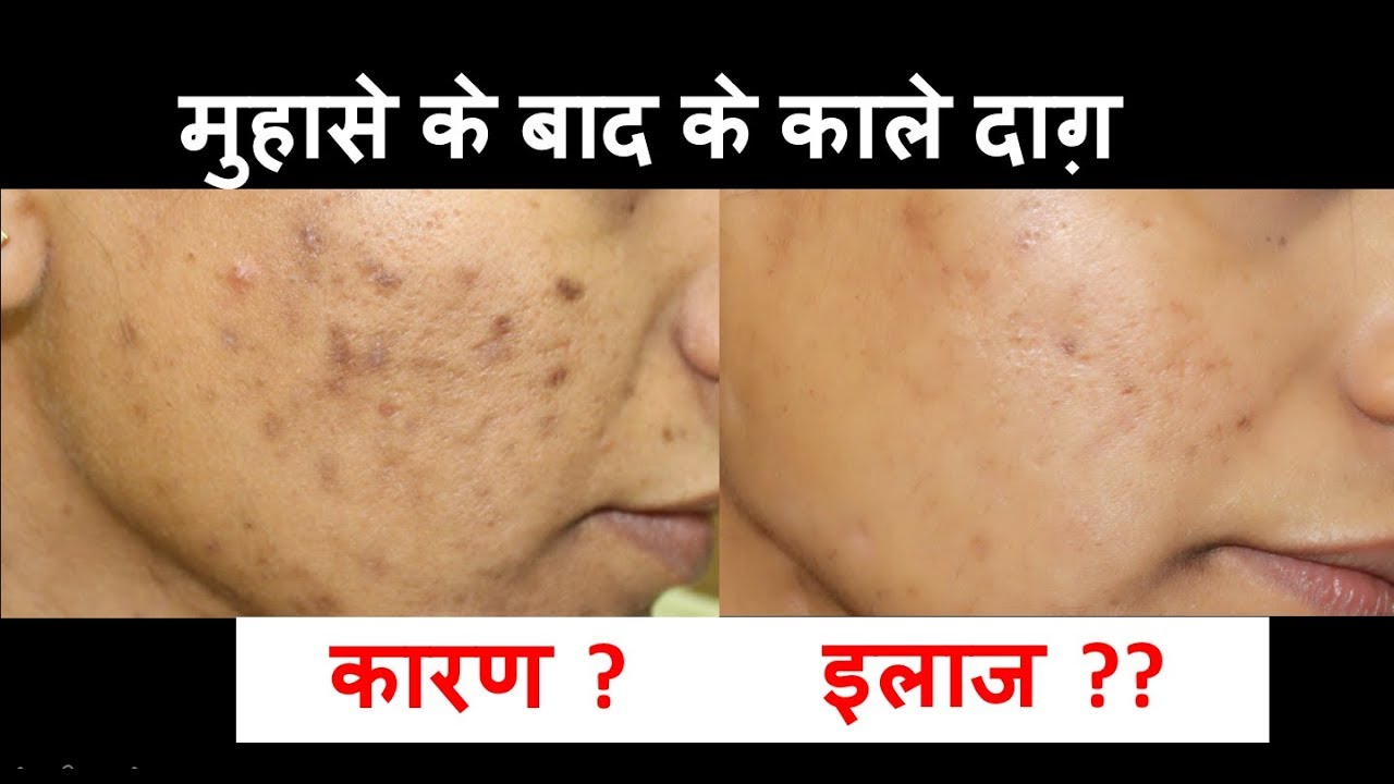 दाग  धब्बे का इलाज  | हिंदी में | डा. आँचल पंत