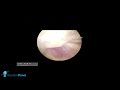 ARTHROSCOPIC MANAGEMENT OF SUPRASPINATUS PASTA LESION