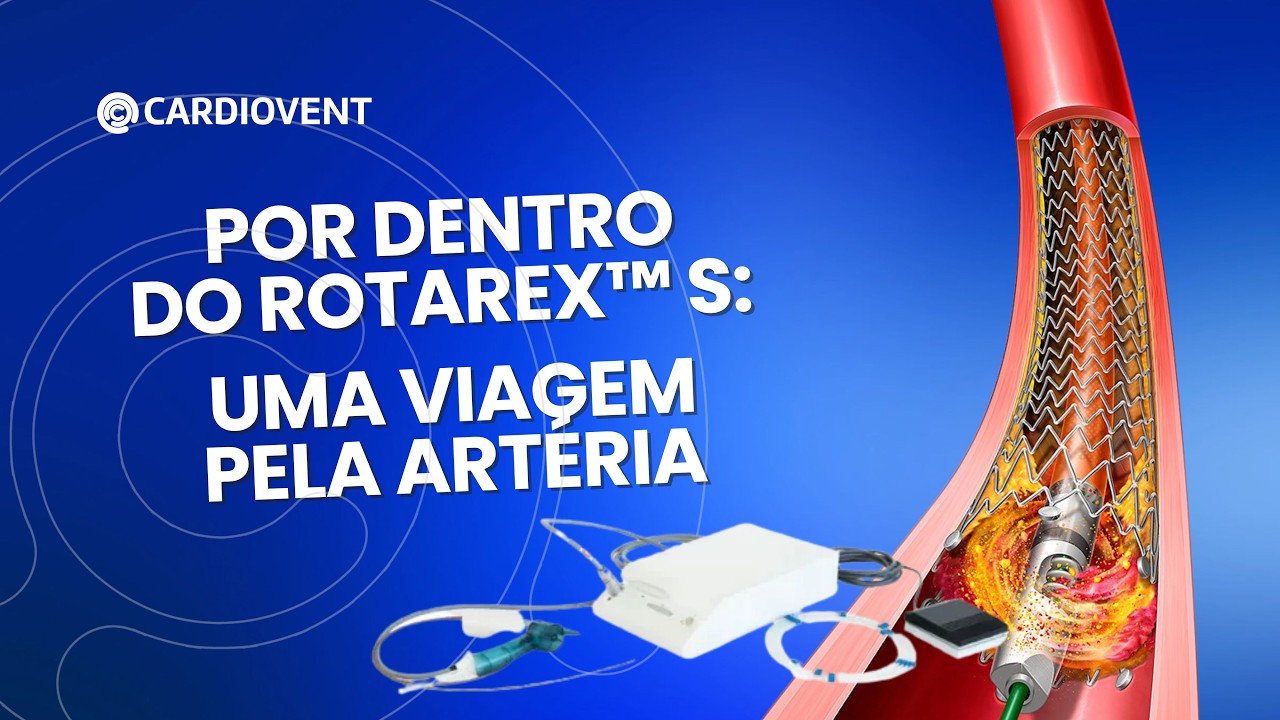 Tirar o obstáculo antes de escolher o tratamento: o que a evidência diz sobre o Rotarex™ S