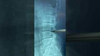 شرح عام عن Lumbosacral Spine X-Ray و توضيح الانزلاق الفقري - الدكتور محمد مجذاب الربيعي