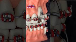 Pick the RED BRACES go on 🔥
