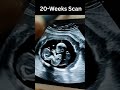 20 Weeks Ultrasound | Baby’s Growth and Movements Inside the Womb 👶✨