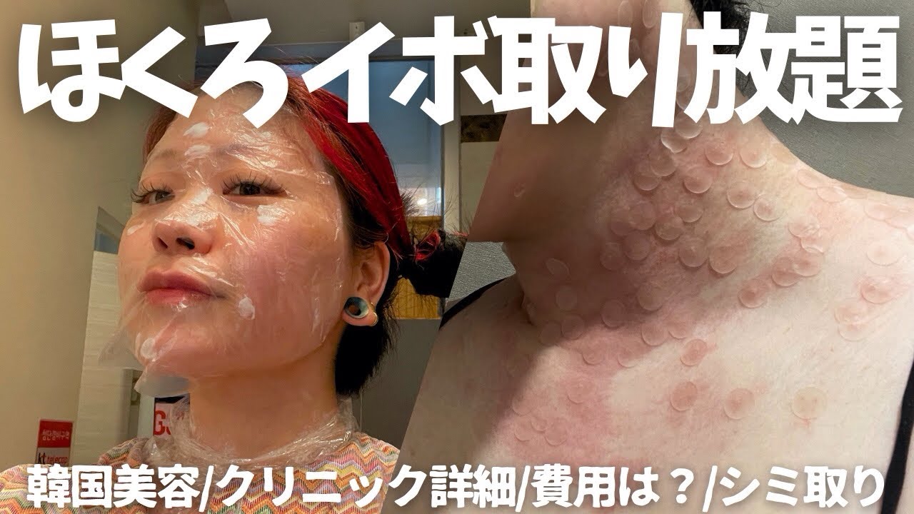 [韓国美容]🇰🇷ほくろイボ取り放題|シミ取りレーザー|正直レポ|リピあり？なし？|DT1ヶ月