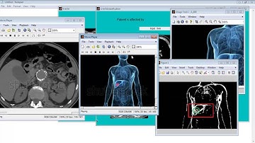 Liver Tumor Segmentation Matlab Code 3D Projects
