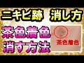 【ニキビ跡　消し方】茶色の着色の消し方