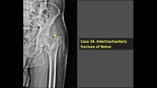 Intertrochanteric Fracture Of Femur X-Ray