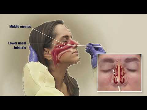 How to Obtain a Nasal Mid-turbinate (NMT) Swab for COVID-19