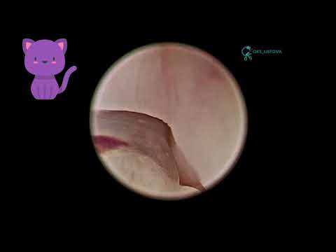 वीडियो: बिल्लियों में नाक का कैंसर (चोंड्रोसारकोमा)