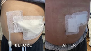 Peritoneal Dialysis Catheter Removal