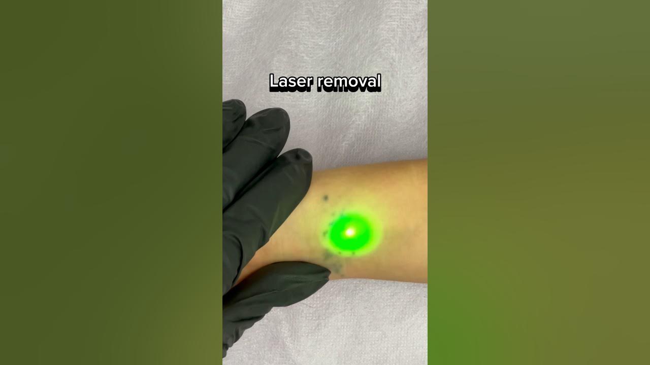 Laser tattoo removal YouTube