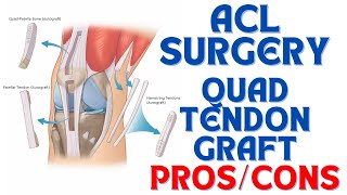 ACL SURGERY Quad Tendon Graft Pros & Cons