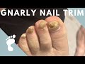 FUNGAL NAIL TRIM