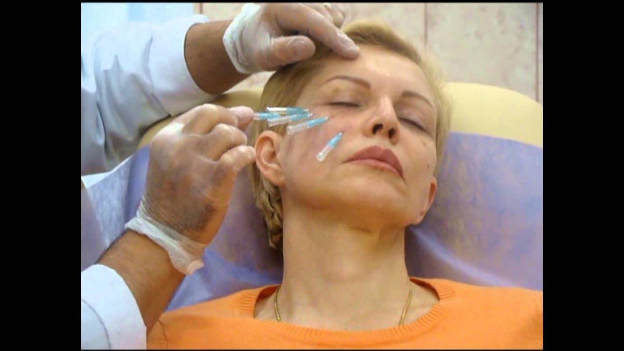 Smas лифтинг. Векторный лифтинг до и после. Векторный лифтинг. Радиолифтинг для лица. Смас лифтинг лица.