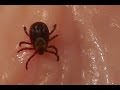 Видео . Могут ли клещи впиться в НЕ живую плоть?