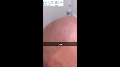 Scalp micropigmentation 1 close up