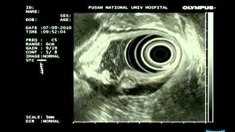 EUS Findings of Gastric Ectopic Pancreas