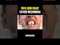 치아가 갈라진것 같다고요? #치아균열