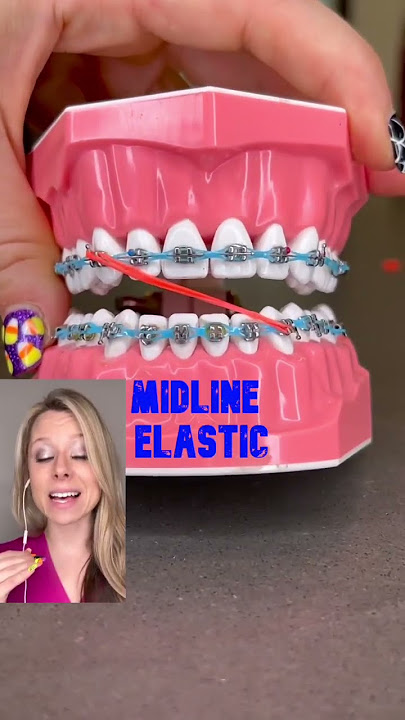 Should you eat with your rubber bands on or off? Let's find out! 👀🦷 , Rubber  Band Braces