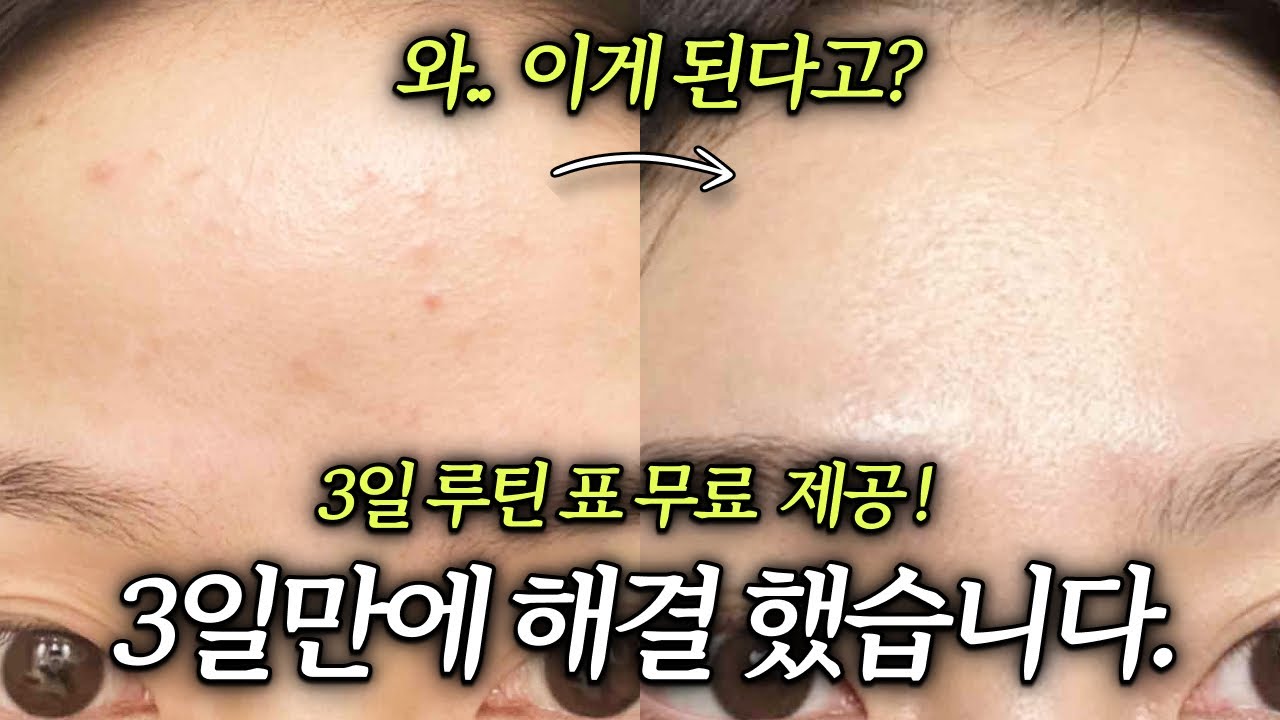 3일만에 여드름 박멸하는 법. 겨울에 ‘이것’모르면 망함.. 제발 3일만 따라해보세요 (3일의기적)