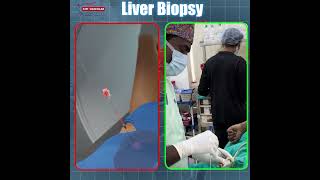 Liver Biopsy Procedure Explained | Is Liver Biopsy Painful? || Dr.Shaileshkumar Garge