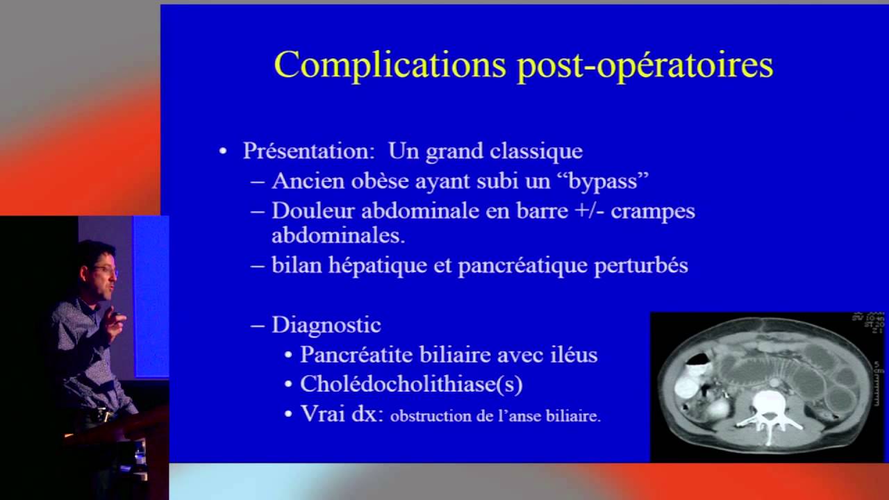 Complications immédiates post procédures bariatriques