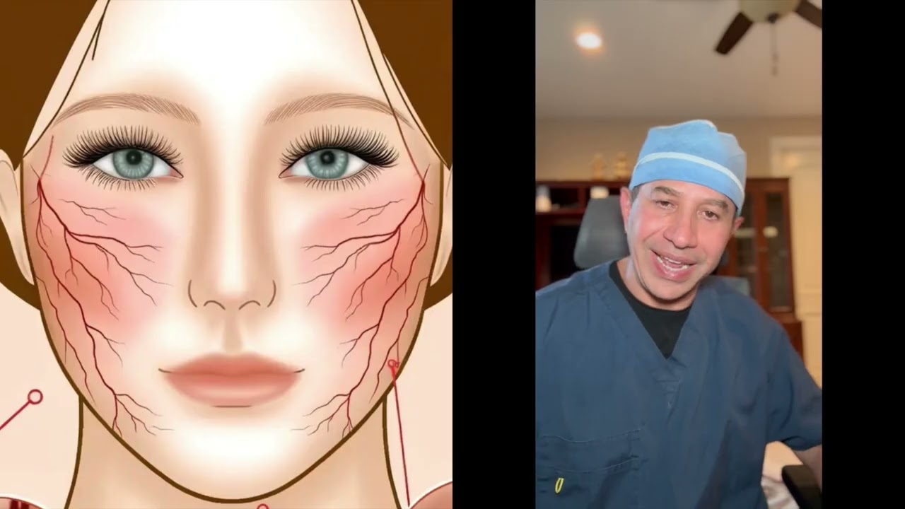 Facial Broken Capillaries after facelift surgery