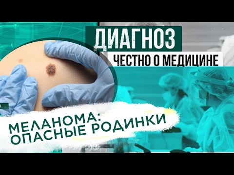 Меланома: как распознать опасные родинки? | Диагноз