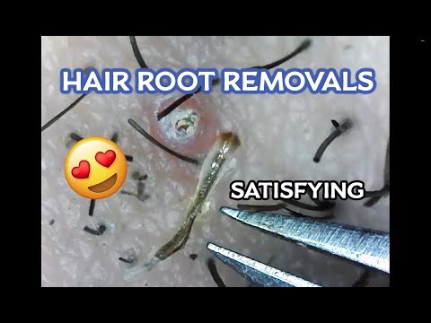 Squishy's #3 Ingrown Hair Root Removals! (Microscopic)