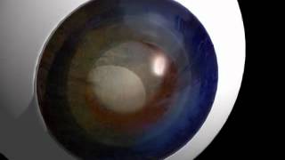 Cataract