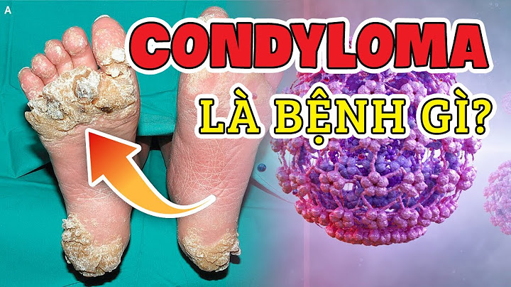 Condyloma phẳng cổ tử cung là gì năm 2024