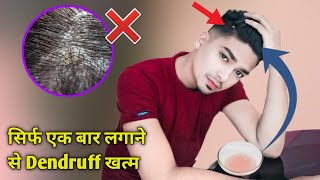 सिर्फ 10 मिनट में Dendruff दूर हो जाएगा | Remove Dendruff Permanently at Home